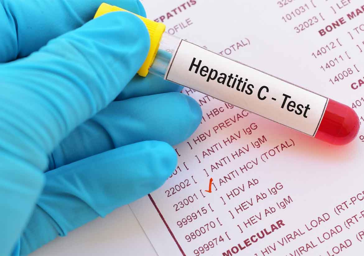Doctor holding vial for hepatitis C test